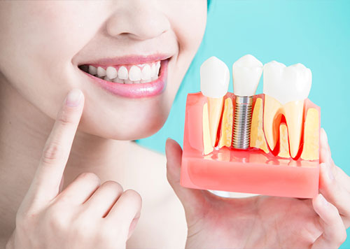 A woman holding an artificial teeth model for indicating dental implants