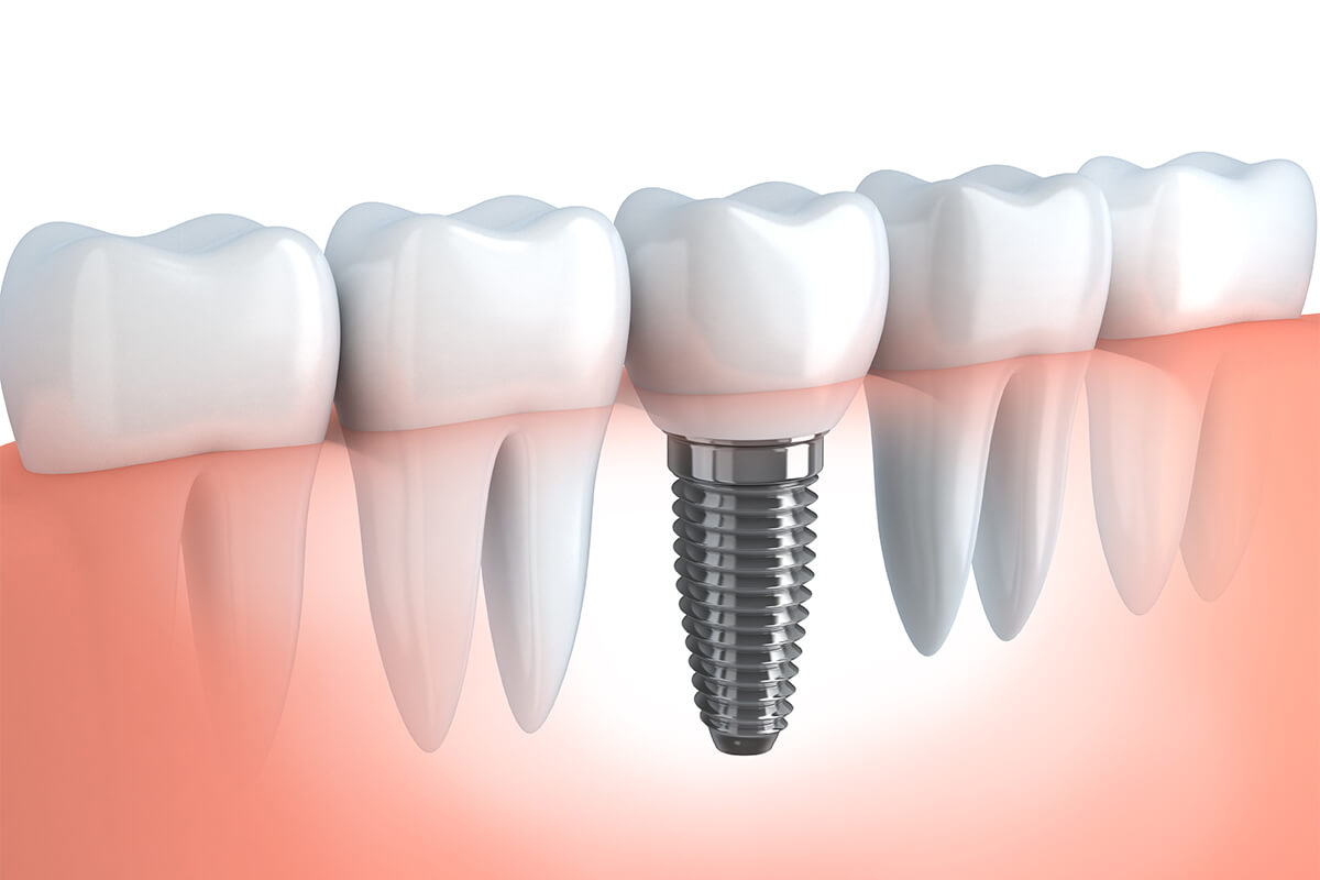 Single Tooth Implant Cost in Chicago IL Area