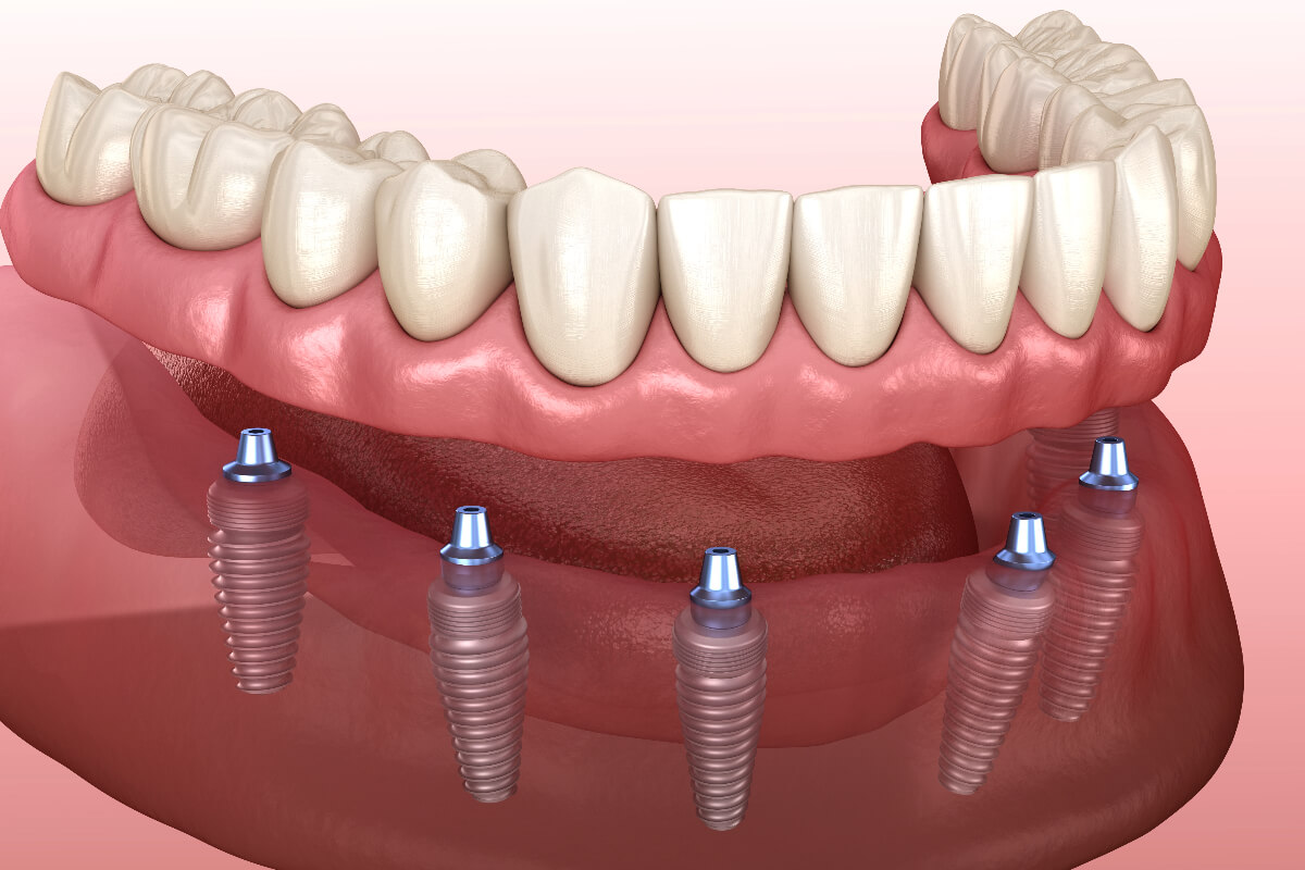 All On 4 Dental Implants in Chicago IL area