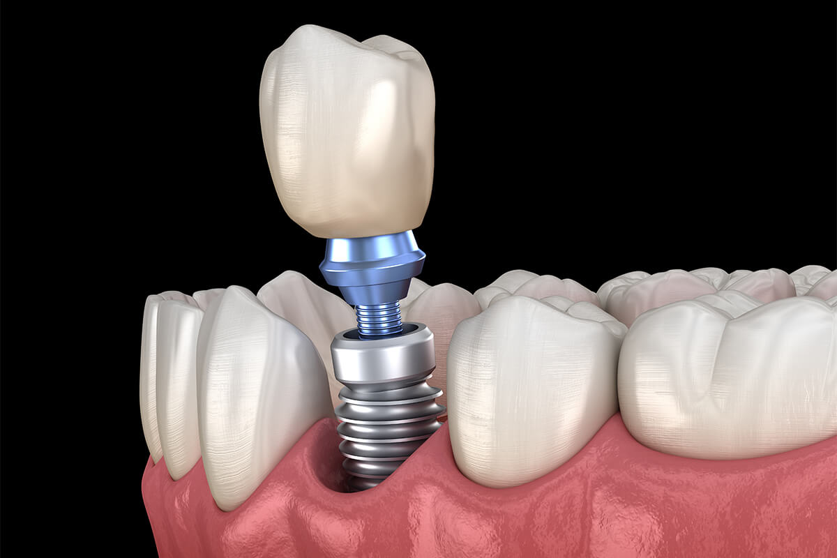 Same Day Dental Implants in Chicago IL Area